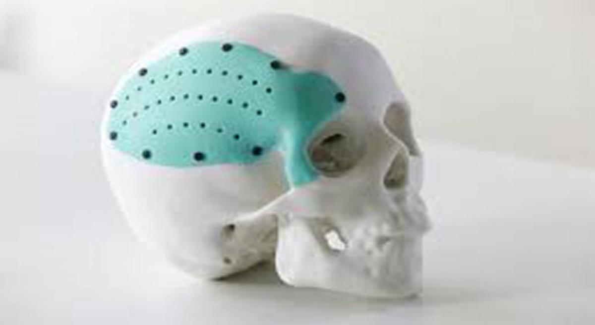 3D printing technology enables precision skull implant on patient with traumatic brain injury