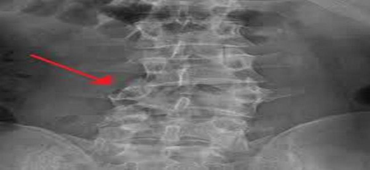 Magnetic kyphoplasty can now heal spinal fractures