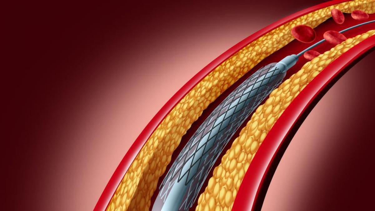 Government Tells Hospitals To Follow Notification On Capping Stent Prices