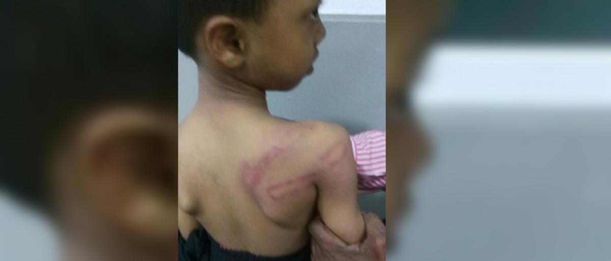 Kid beaten by teacher; gets welts on body