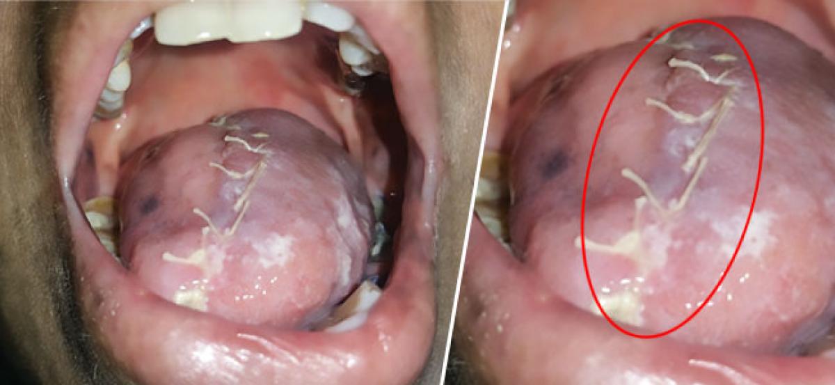 Microvascular free flap transfer helps cancer patient regain use of surgically removed tongue